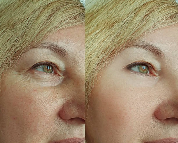 Vita A Retinal shot Tightening booster.